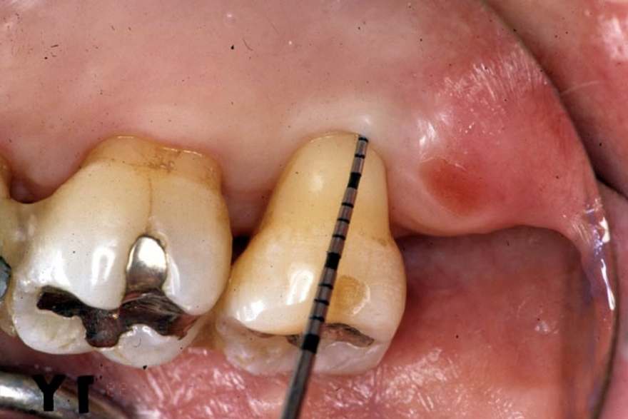 術後１年経過時 再生療法によって歯周ポケット深さが２mmまで改善された。
