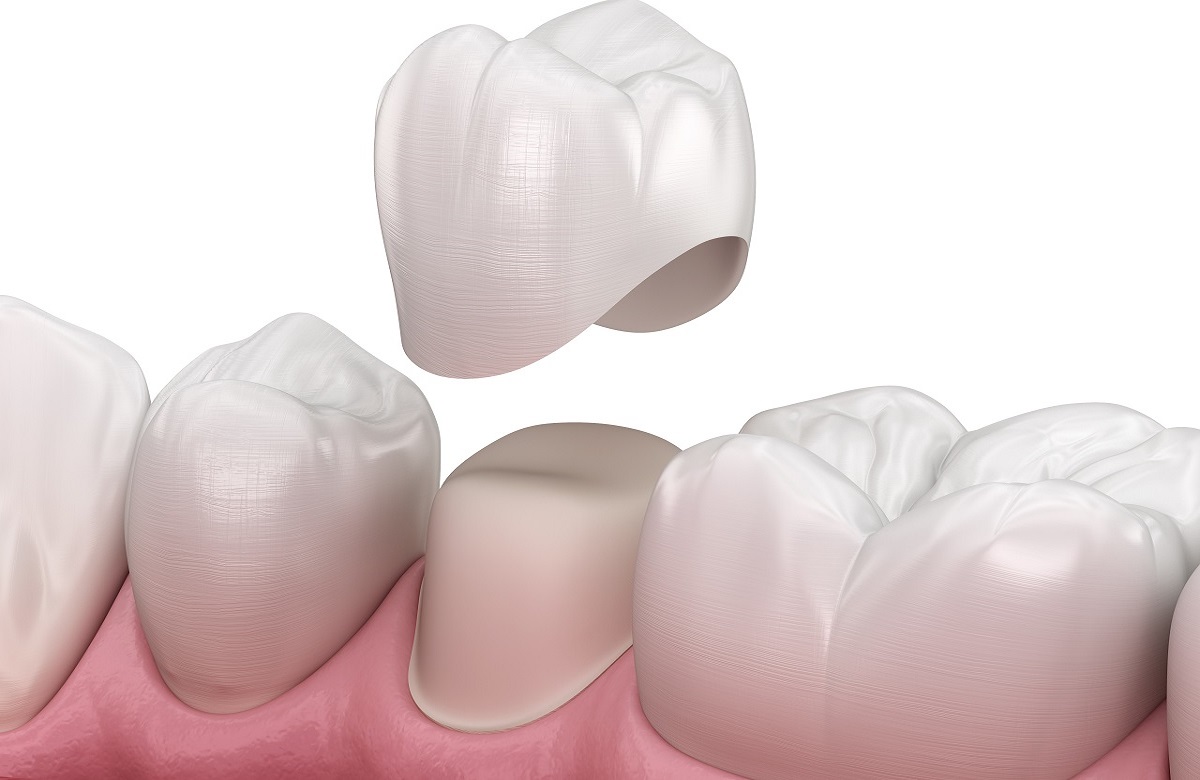 補綴、修復処置や審美性も考慮したトータルな歯周病治療