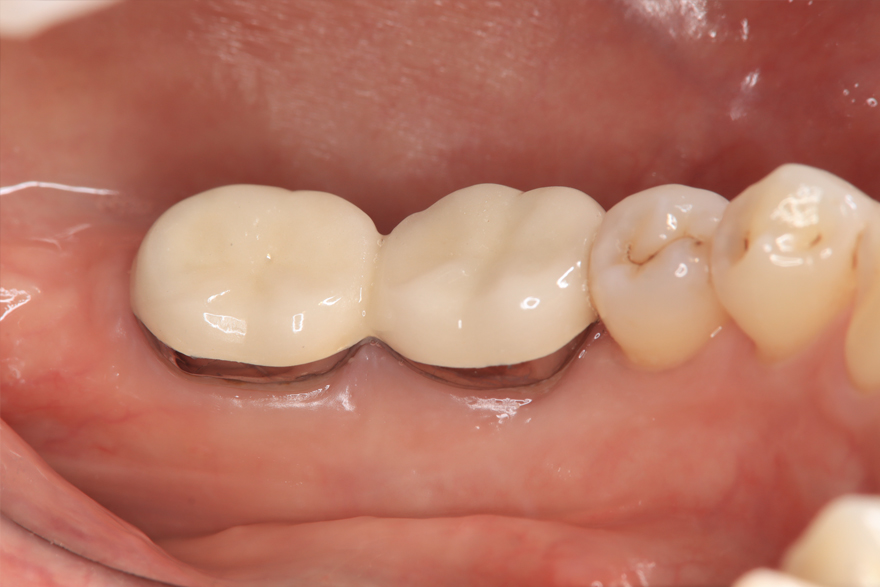 術後２年経過時歯周病治療、再生療法およびメインテナンスによって正常な歯周組織が保たれている。