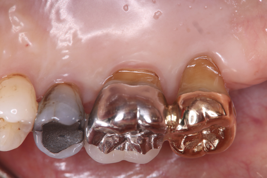 術後２５年経過時 長期的な予後を考慮して左上６７連冠の補綴物を装着している。現在でも健康な歯周組織が保たれている。
