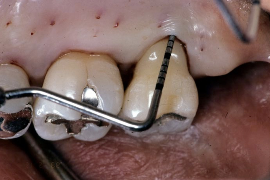 術前 左上７の口蓋側中央から遠心にかけて６mm以上の歯周ポケット深さを認めた。